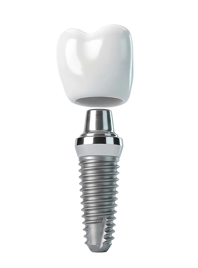 A ceramic crown above a titanium dental implant